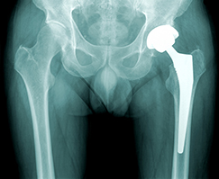 knee replacement surgery